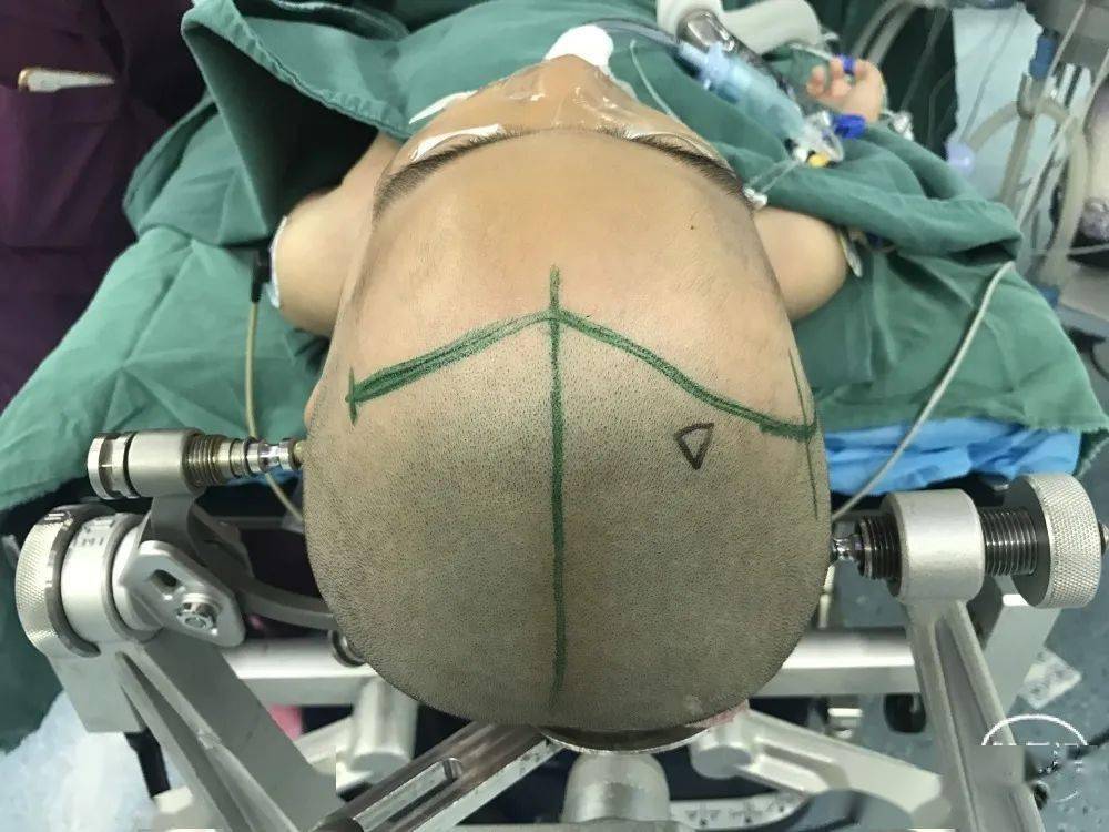 额底纵裂入路是通过双额发迹内的冠状切口,行右额或左额的骨瓣成形