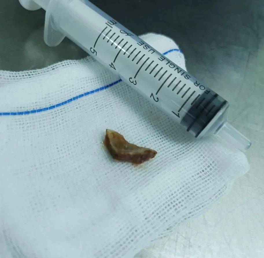 鄂尔多斯市中心医院健康提醒!_异物_儿童_气管