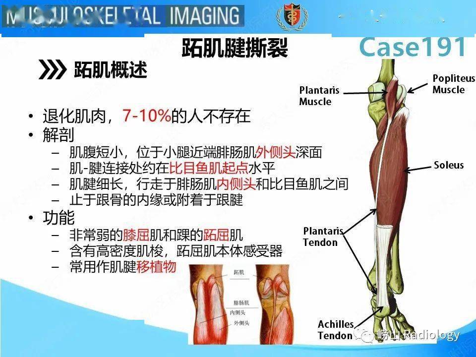 跖肌腱撕裂