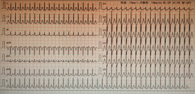 心跳过快心电图图片