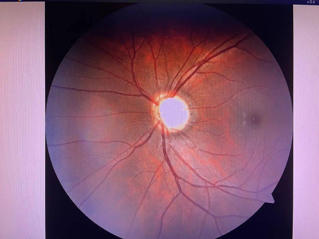 视野_眼压_视网膜