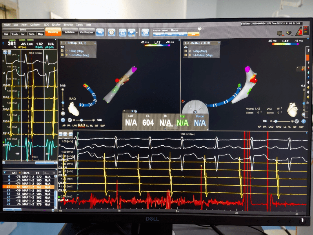 会宁县医院手术室传来好消息_综合征_心电图_患者