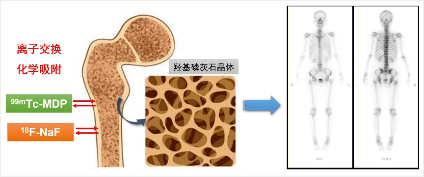 仁济科普 | 核医学"画骨"神器——全身骨显像_骨骼_病变_肿瘤