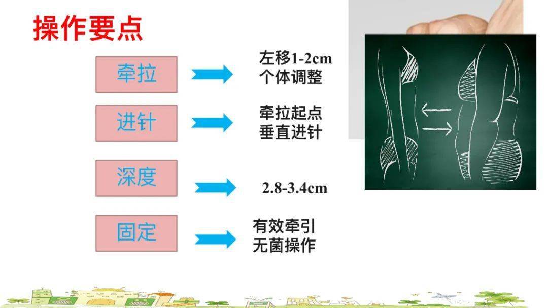 ppt z型注射法了解一下