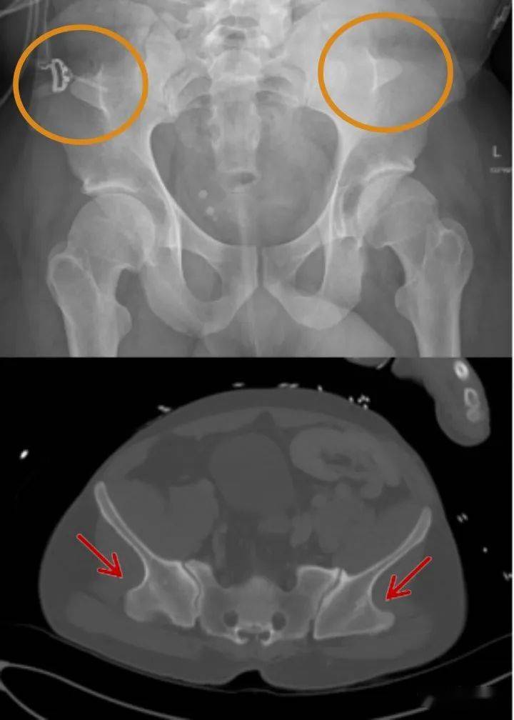 见到髂骨角,一定要想起这个少见病