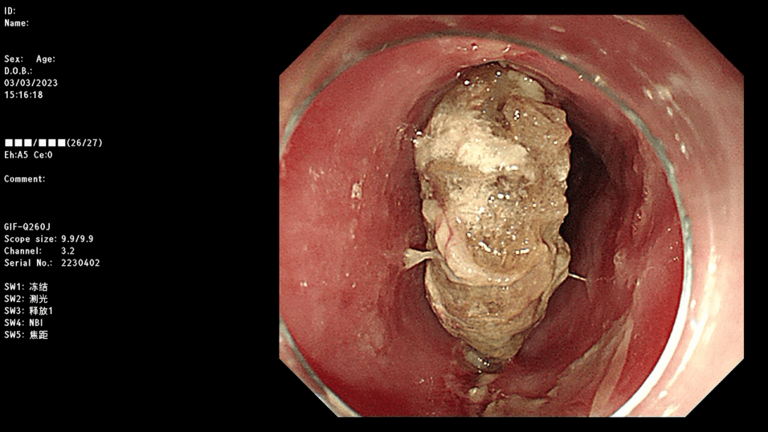 【胸科故事】大爷误吞牛骨卡住食管命悬一线 北京胸科医院消化内镜