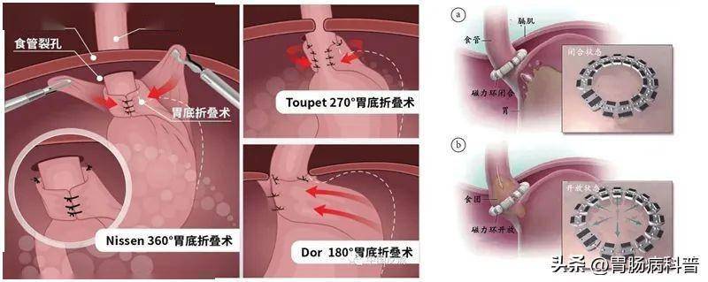 基于大量的临床病例和研究,国内外最新的胃食管反流病诊疗指南都推荐