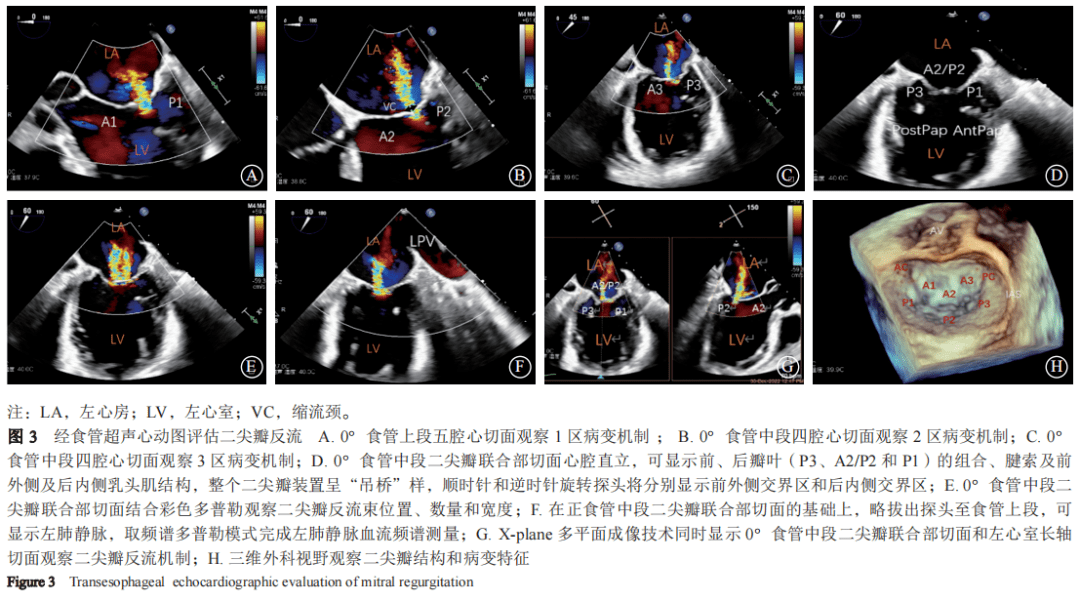 tte)与经食管超声心动图(transesophageal echocardiography,tee)