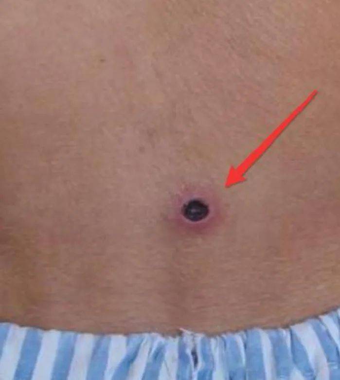 恙虫叮咬后,并不会产生痛感及瘙痒感,而是会形成圆形黑色焦痂,周围有