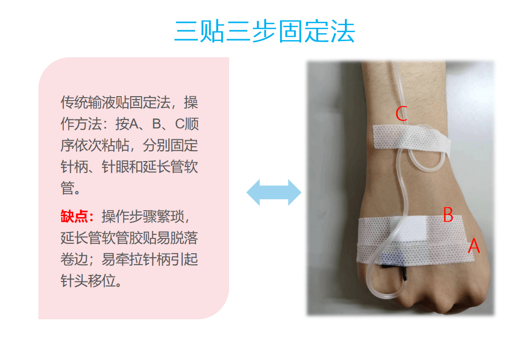 输液胶布固定方法图片图片