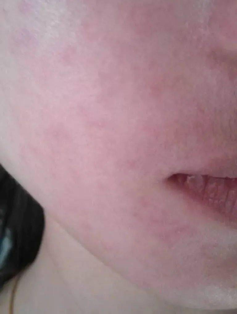 皮肤对阳光过敏紫外线导致的这种皮肤病要小心