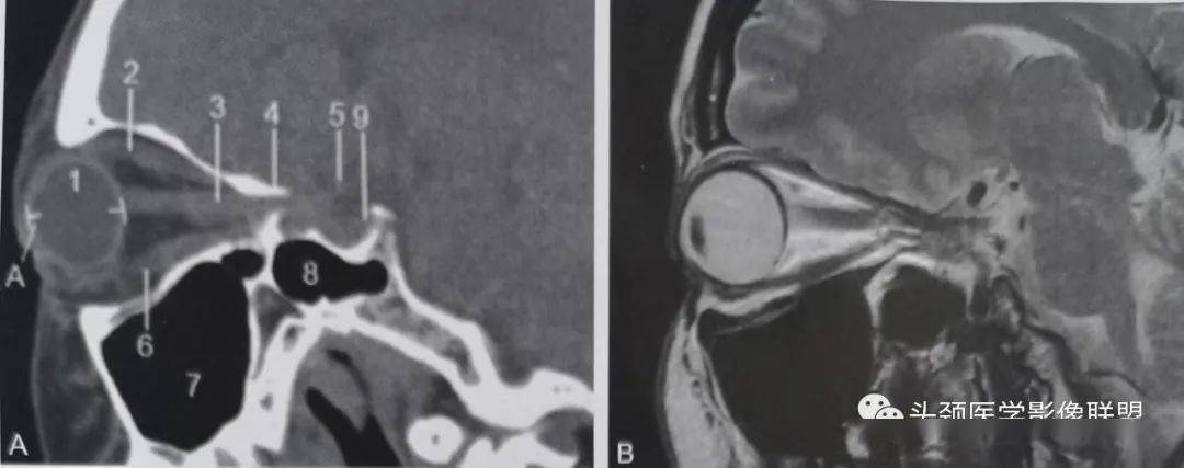 眼眶解剖(x线/ct/mri)和常见变异及误判_mm_眼球_直径