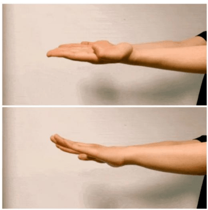 双手伸直,迅速地做翻掌动作,就是手掌向上向下做轮替动作,帕金森的