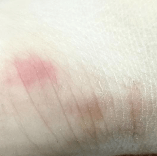 图片来源：网络暴露二级：裸露的皮肤被轻咬，无出血的轻微抓伤或擦伤。