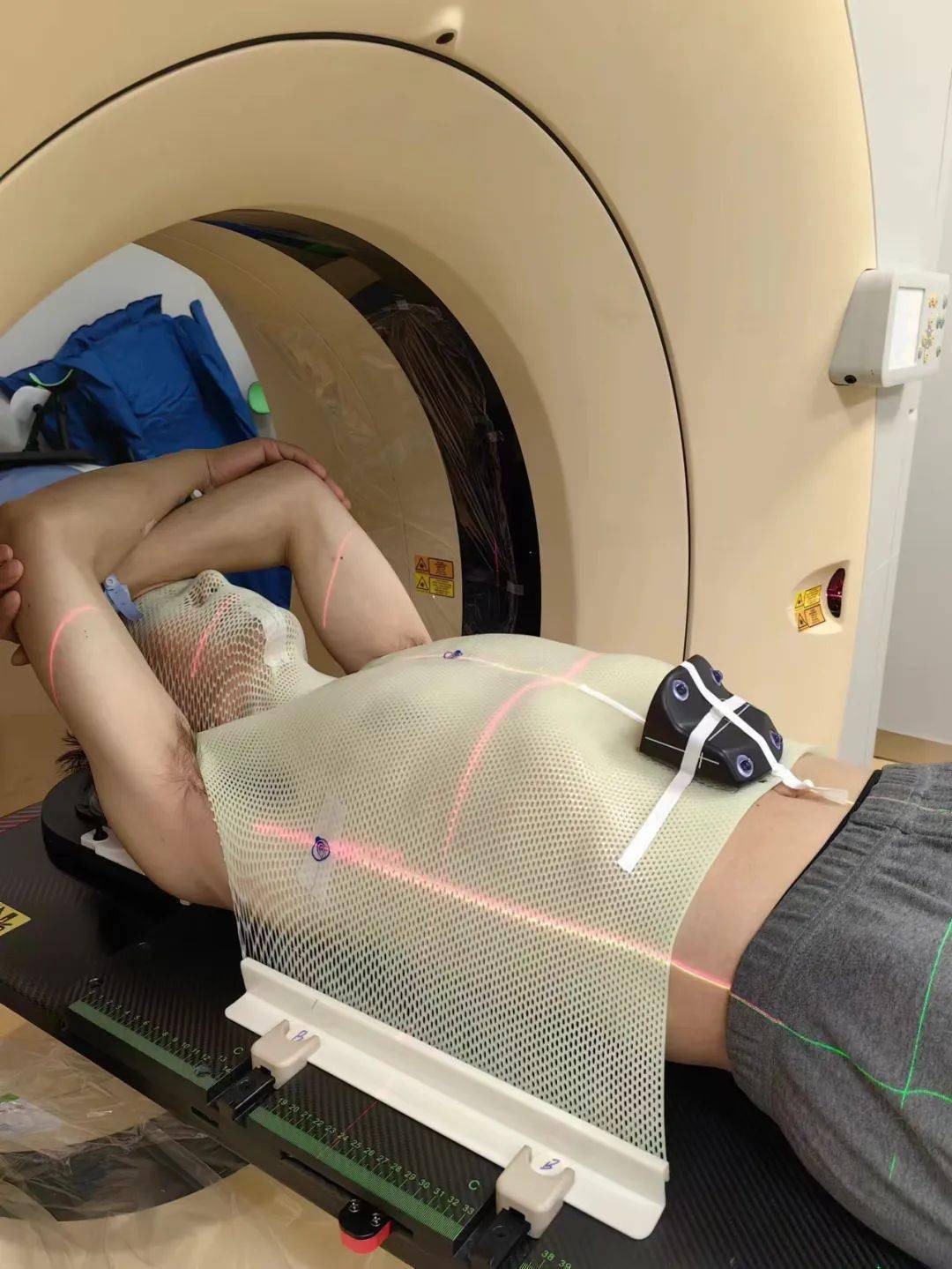 呼吸门控放射技术是精准放疗中的"硬核武器",是目前国内最先进的一种