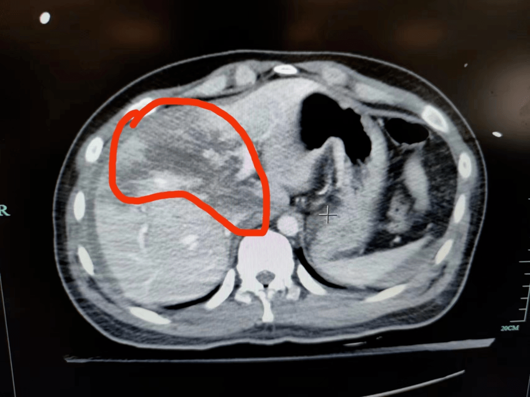 20岁的他,肝脏大范围破裂!