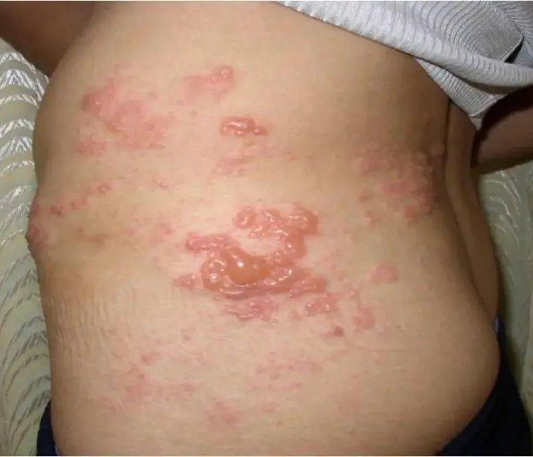 专家在身边丨像"苔藓"般蔓延!眼角的"斑点"竟是瘤?还牵出许多毛病.