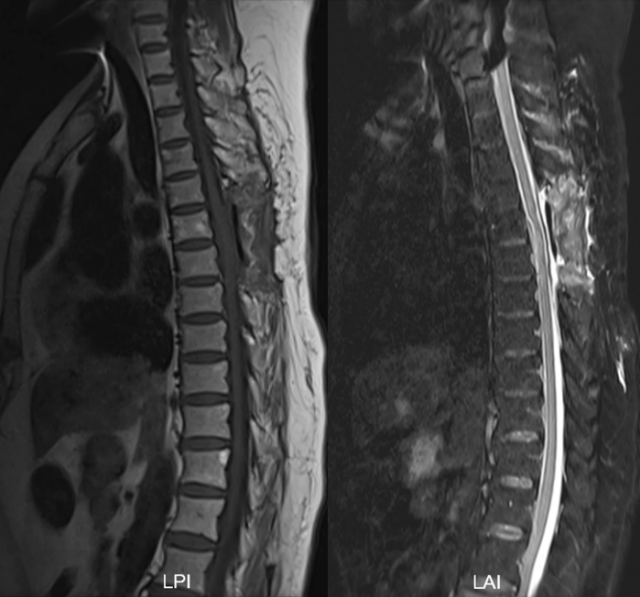 术后胸椎磁共振平扫(图3):术后明确病史,排除外伤以及医源性因素,最终