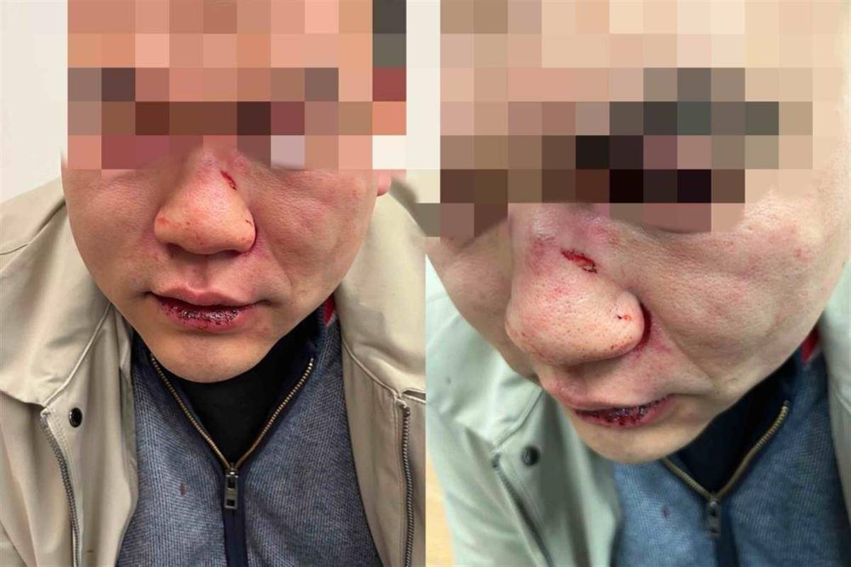 中国男子在伦敦被殴打致眼眶骨折，袭击者却获保释，受害者网络发帖找到7名证人