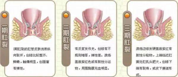 哨兵痔图片 来自搜狐网