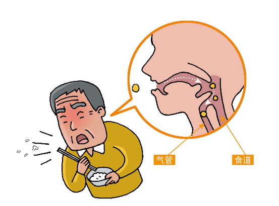 医生:很有可能是吞咽障碍!_康复_患者_食物残渣