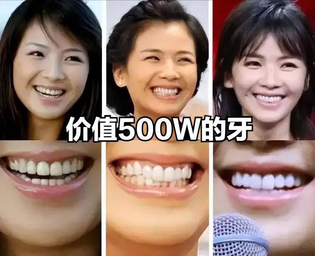 烤瓷牙的确效果明显,让刘涛拥有了一口洁白的牙齿,但整个过程和后期的