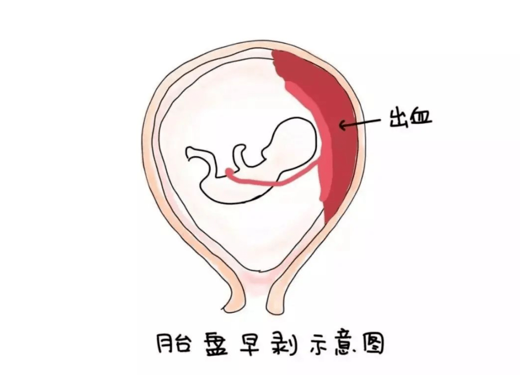 胎膜图片,胎盘图片胎膜 - 伤感说说吧