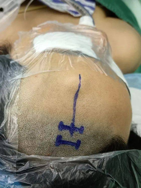 爱美女士罹患额骨骨瘤,"无痕"术式为她留住颜值!_手术_民强_恩施