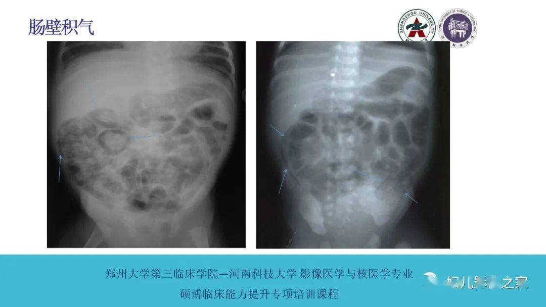 新生儿坏死性小肠结肠炎