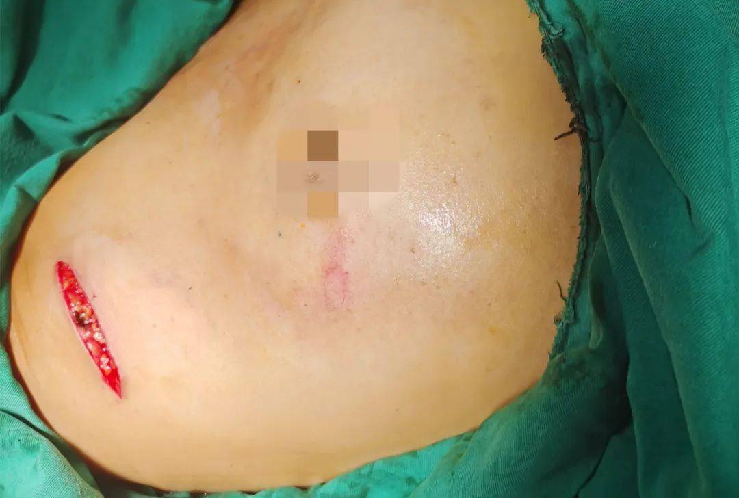 乳腺癌切除手术后照片图片