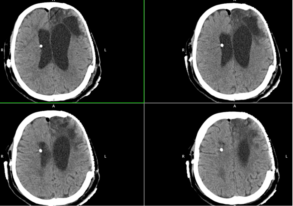 67复杂性难治性脑积水之脑动脉瘤术后继发脑积水| 4次手术仍颅内