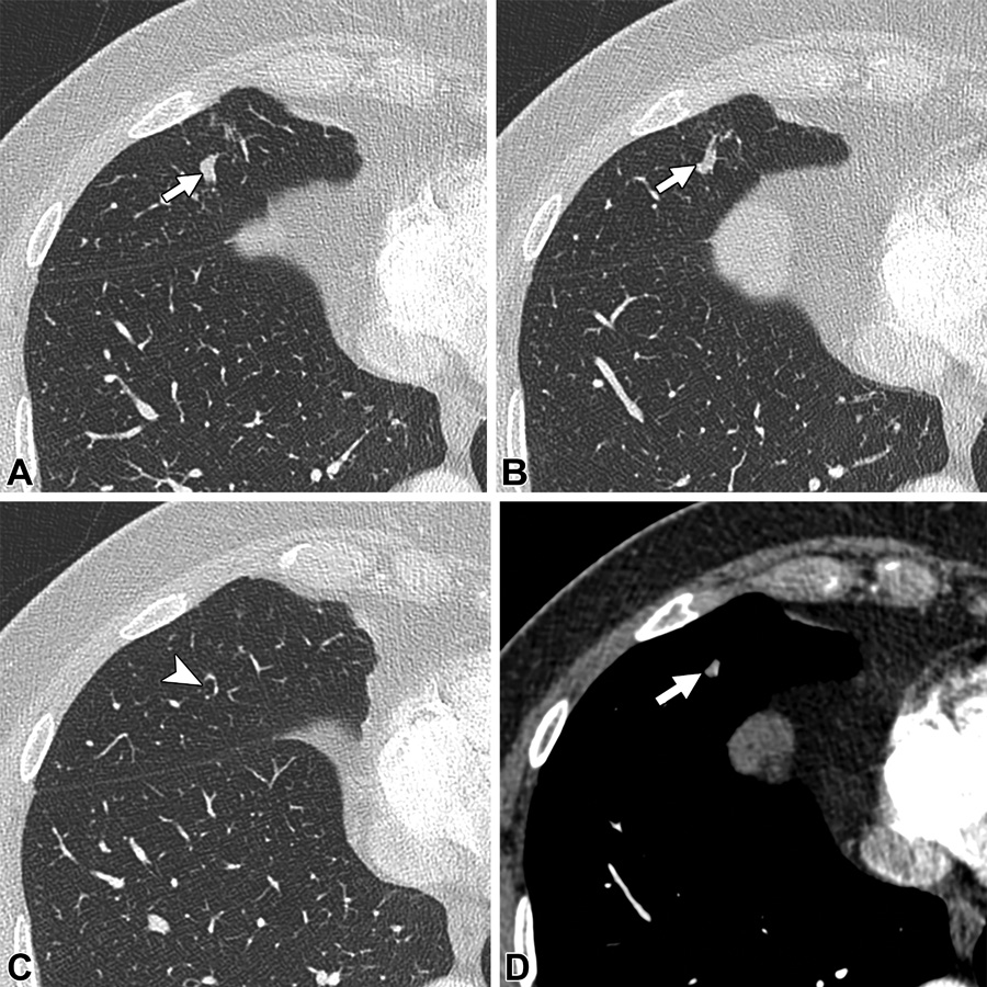 肺动静脉畸形及类似病变的ct表现
