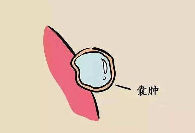 真性囊肿是因为正常或异常的分泌物聚集而形成的,假性囊肿是因为外伤