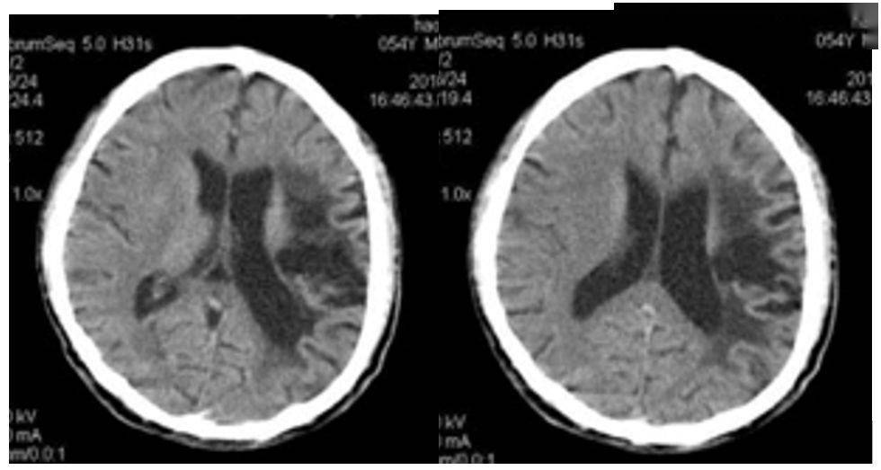 脑白质和脑灰质ct图片图片