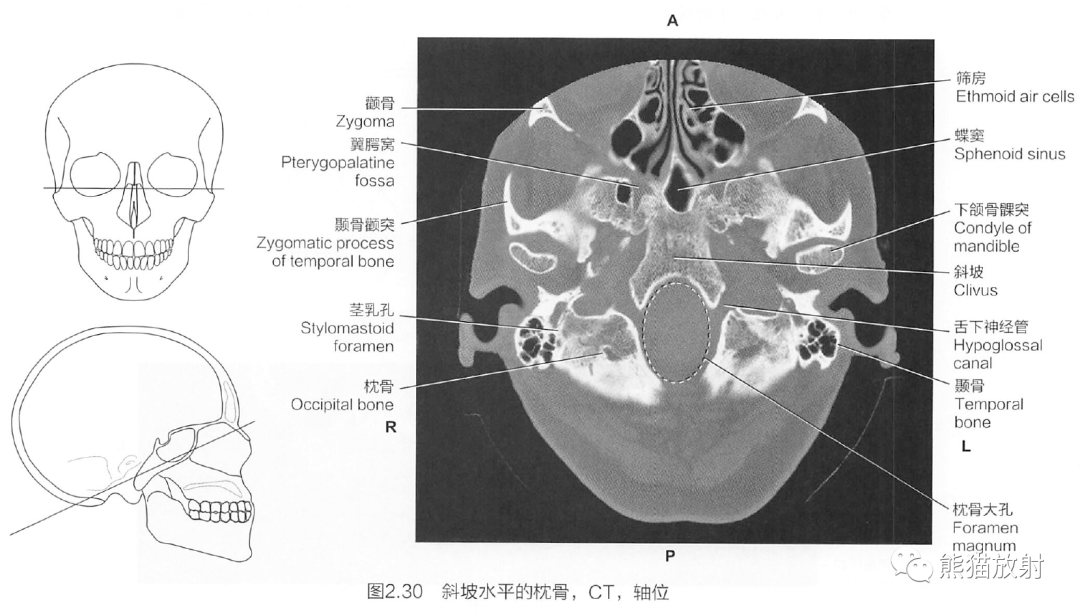 蝶骨在脑中的位置图片图片