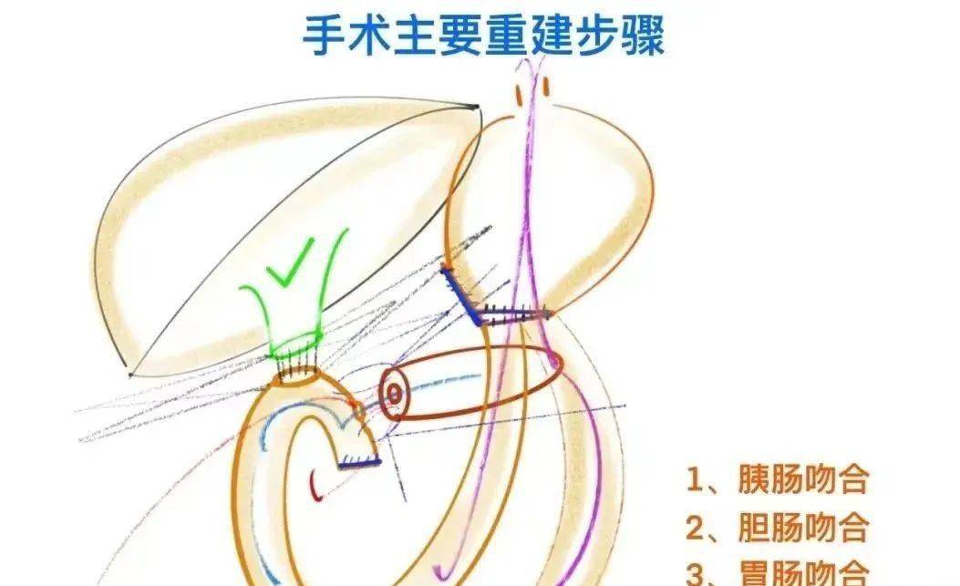 这种手术在普外科领域难度系数非常大,在如此高龄高风险