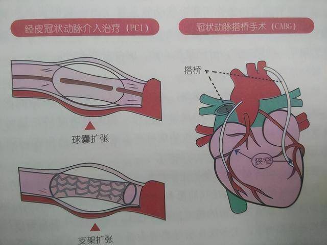 升陷汤治疗调理冠脉支架加搭桥术后心绞痛_患者_胸痛_血瘀