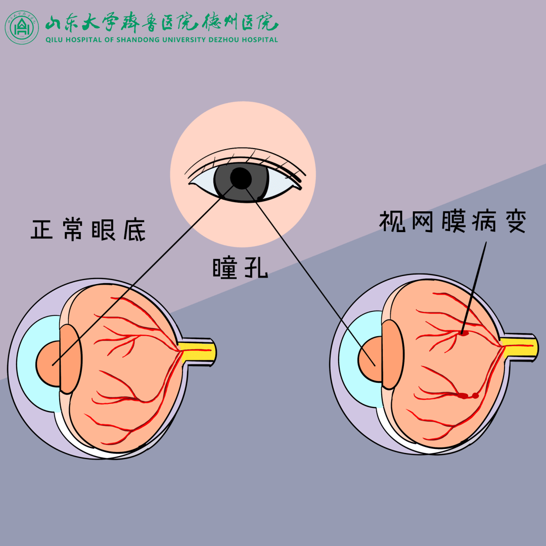 眼睛健康的第一道"安检门"|爱护眼睛从重视新生儿眼底筛查开始_检查