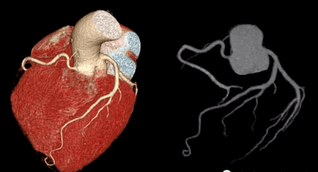 冠状动脉cta检查让心脏血管病变无处遁形!