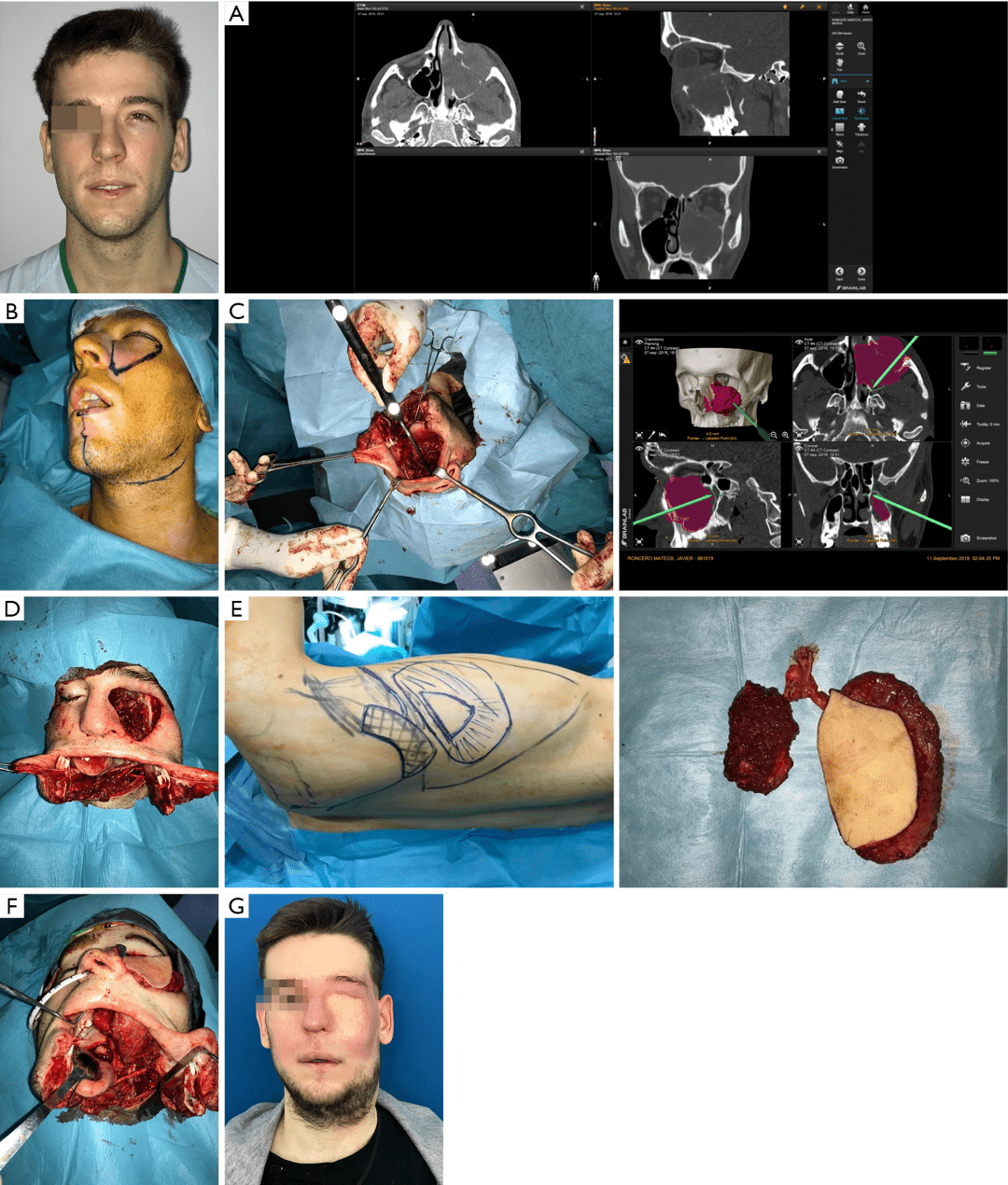 图7 一例23岁累及眶上颌区域的横纹肌肉瘤男性患者(a)ct示病变; (b)
