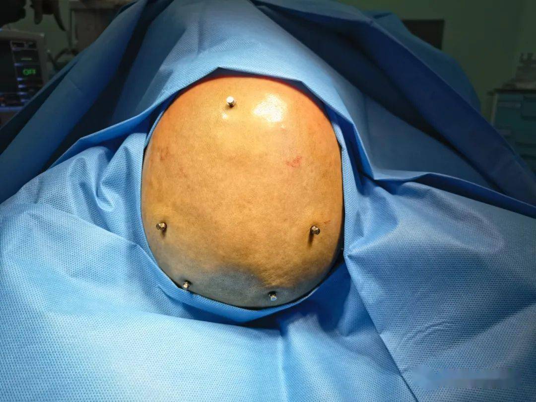 市第一人民医院成熟运用"脑起搏器"技术治疗帕金森_患者_手术_神经