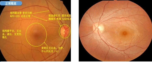 【汤医科普】眼底一张照，眼底疾病早知道_视网膜_病变_黄斑