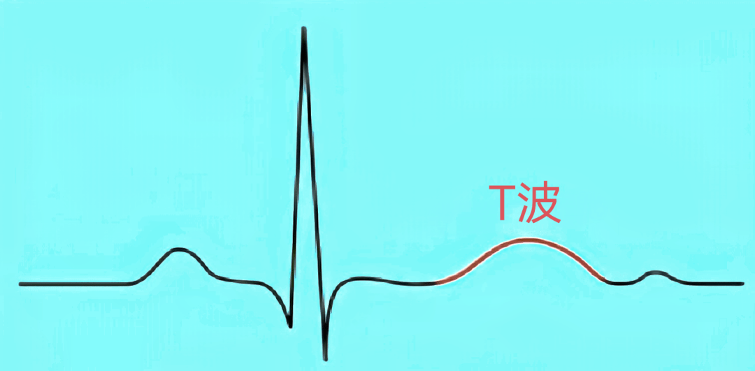 年轻人心电图t波高尖图片