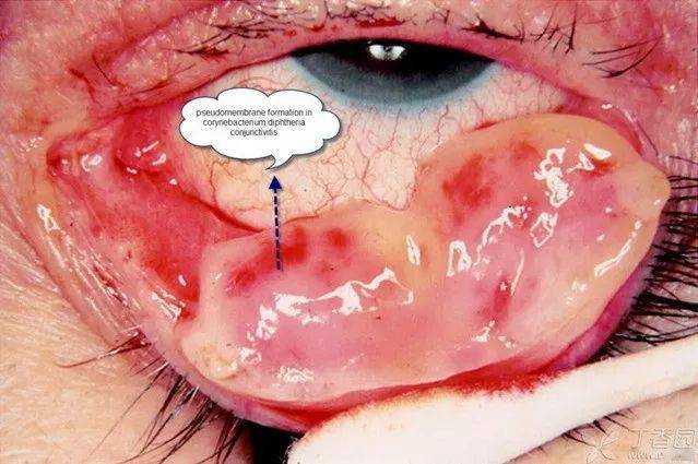 结膜炎白色分泌物图片图片