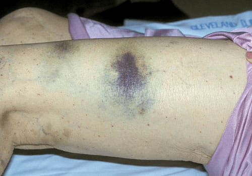 等,可因休克,呼吸衰竭,弥漫性血管内凝血(dic)等多脏器功能衰竭死亡