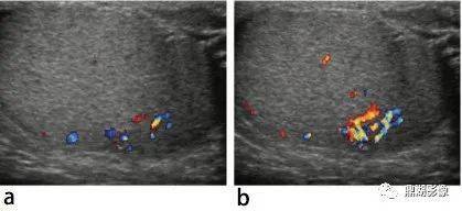 渔网状睾丸,小蛋蛋,睾丸微石症 男性不孕症患者的影像学表现
