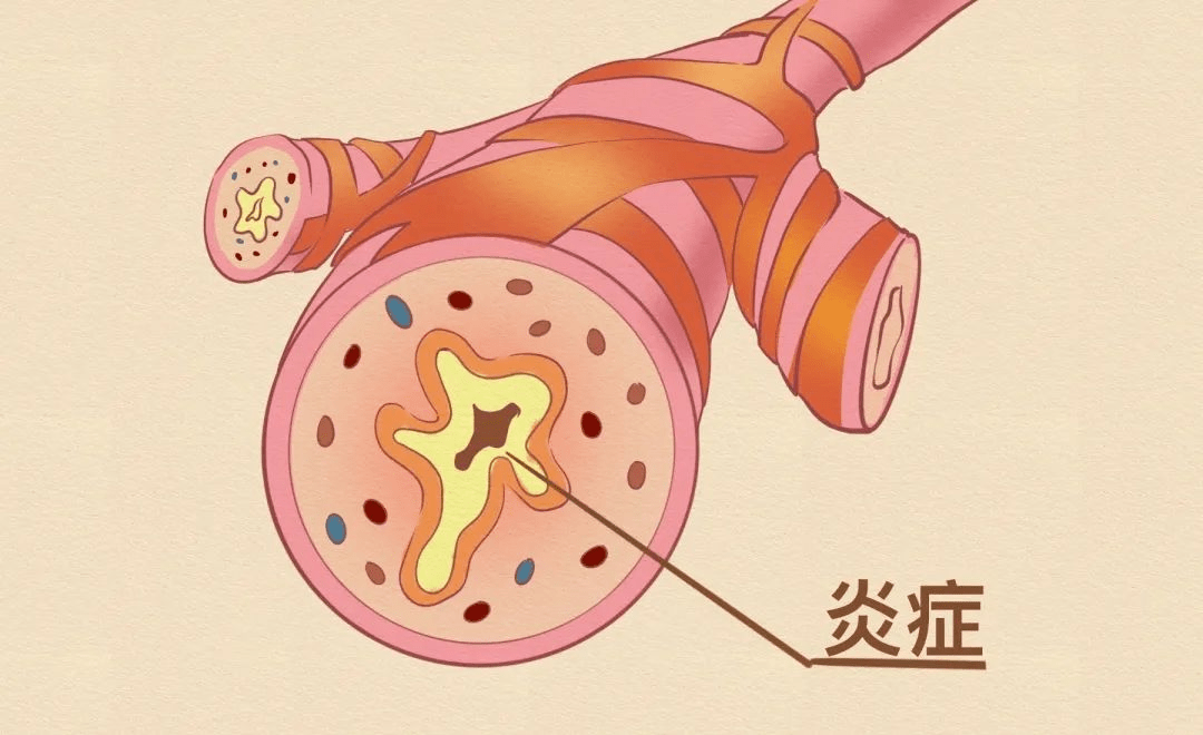 防御过程中会导致呼吸道黏膜破坏,会有大量病毒残留在呼吸道上,这就是