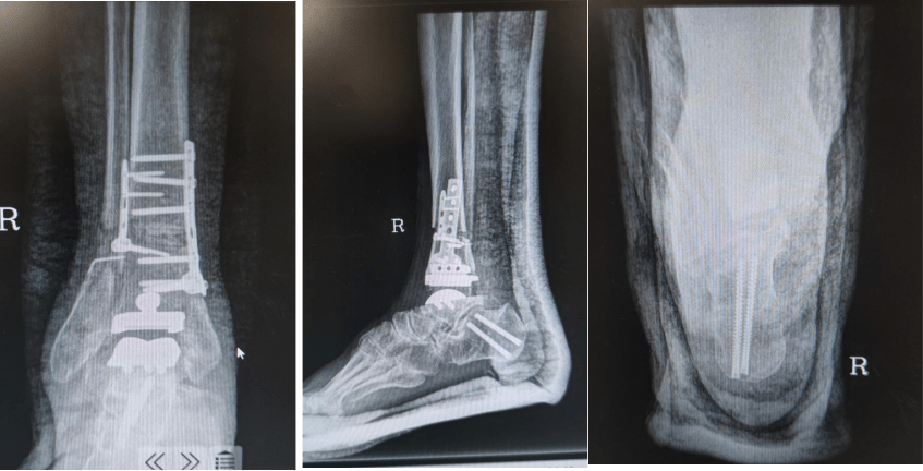 护士配合下,成功为该患者实施了3d打印导板辅助双定制人工踝关节置换