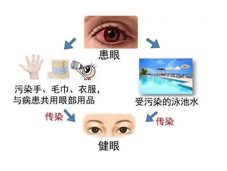 "红眼病"的传播途径是什么?