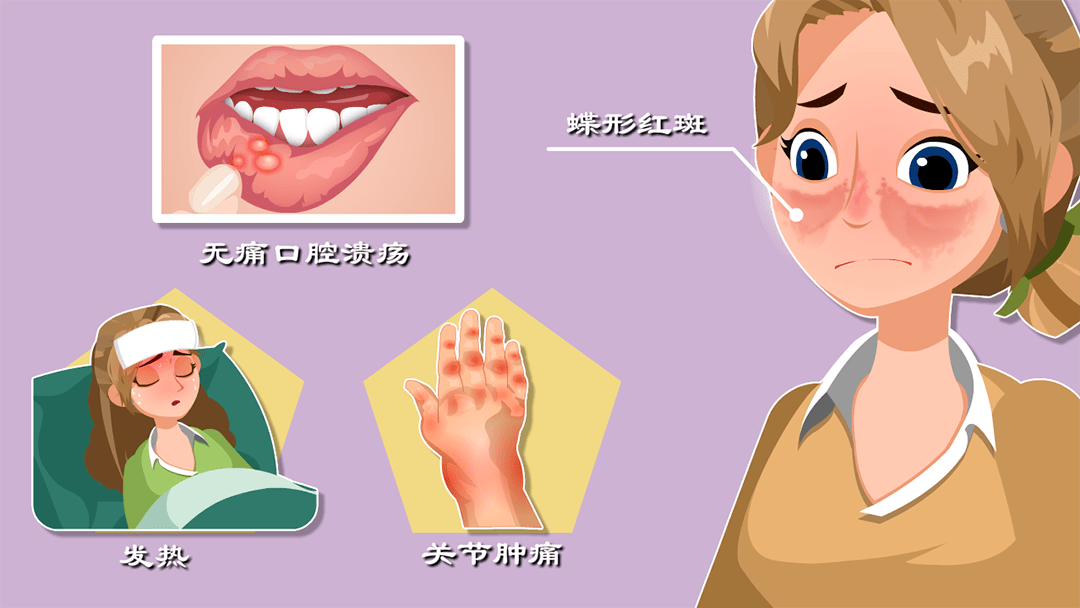 系统性红斑狼疮的病因复杂,与遗传,性激素,环境(如病毒与细菌感染)等